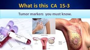 CA15.3 ( BREAST CANCER MARKER )